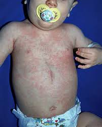 roseola infantil